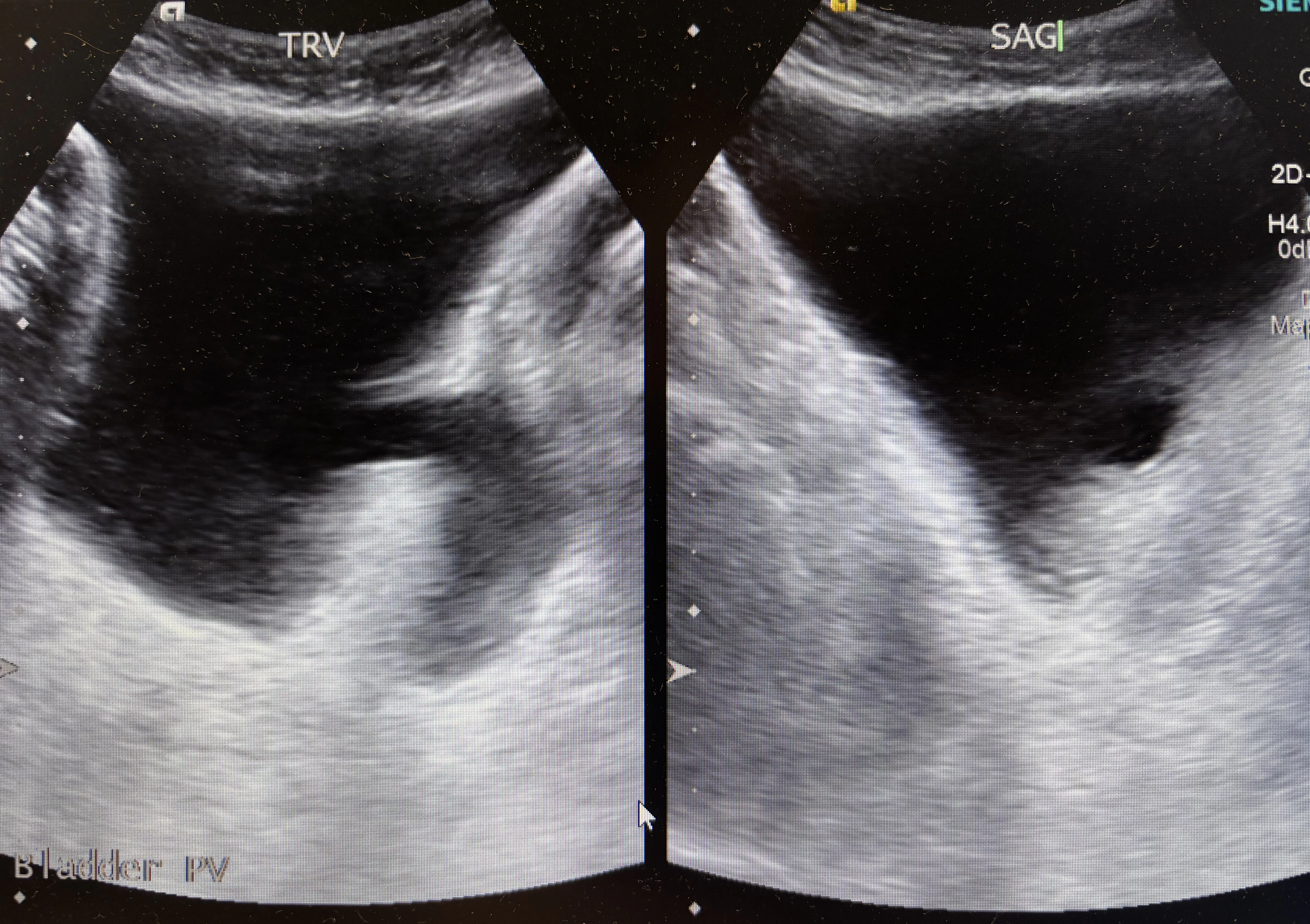 Urinary Tract & Male Reproductive System › Bladder › Bladder diverticulum